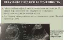 Признаки замершей беременности на 15 неделе