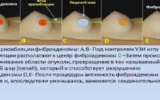 Через сколько можно беременеть после удаления фиброаденомы