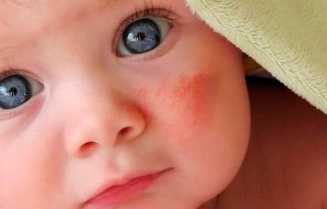 атопический дерматит на лице ребенка