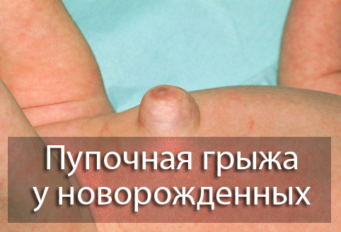 пупочная грыжа у ребенка